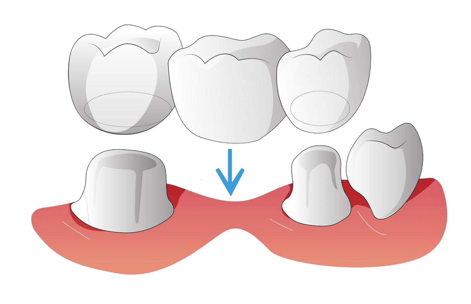 dental bridge showing how missing teeth are replaced at Page Family Dentistry in River Falls, WI to restore function, appearance, and confidence.