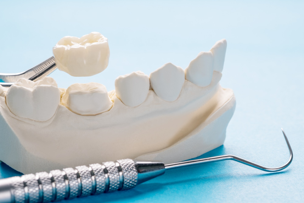 Close-up of dental model showing placement of same-day crowns at River Falls Dentistry
